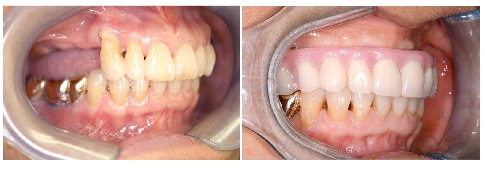 Условно-съемные зубные протезы на имплантах цена